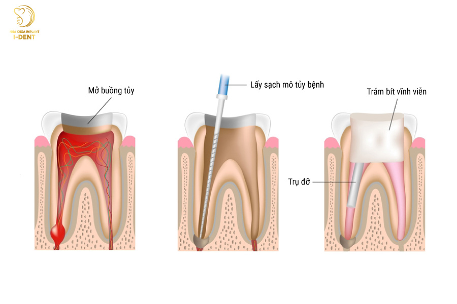 Trám răng có cần lấy tủy hay không? Trám răng có cần lấy tủy hay không?