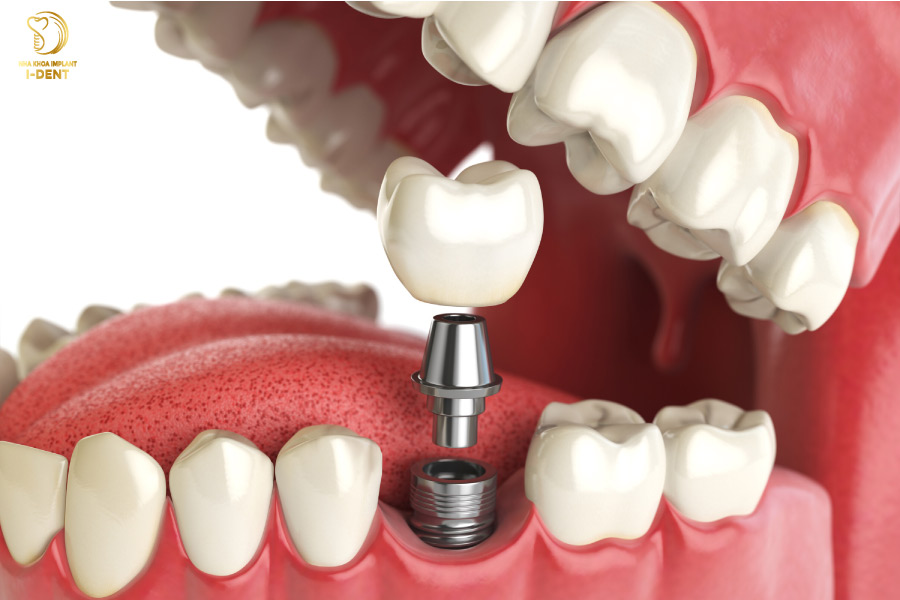 Nếu đủ điều kiện thì có thể cấy trụ Implant ngay sau khi nâng xoang Nếu đủ điều kiện thì có thể cấy trụ Implant ngay sau khi nâng xoang