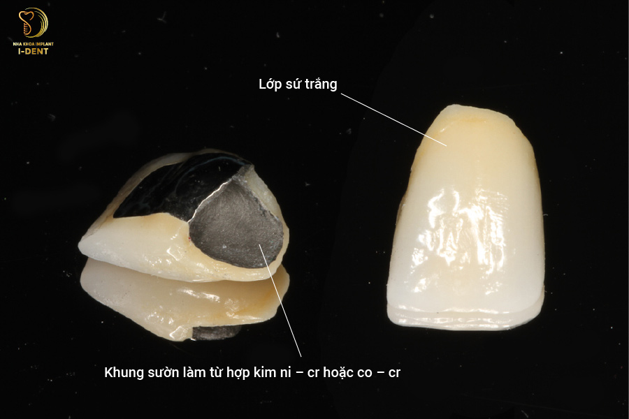 Răng sứ kim loại Răng sứ kim loại