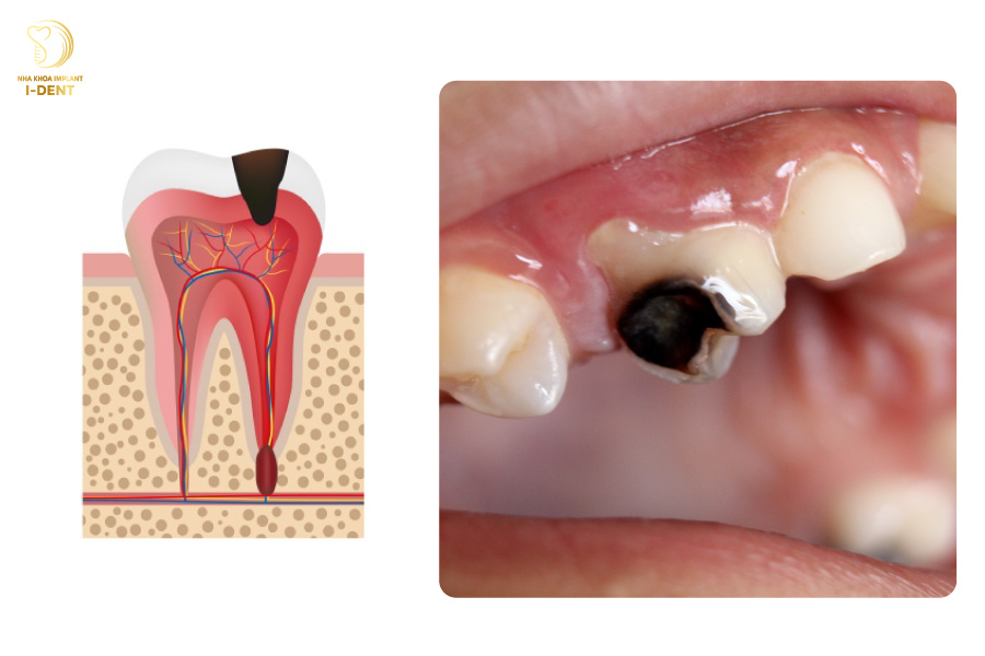 Sâu răng độ 3 ( Sâu đến tủy răng) Sâu răng độ 3 ( Sâu đến tủy răng)