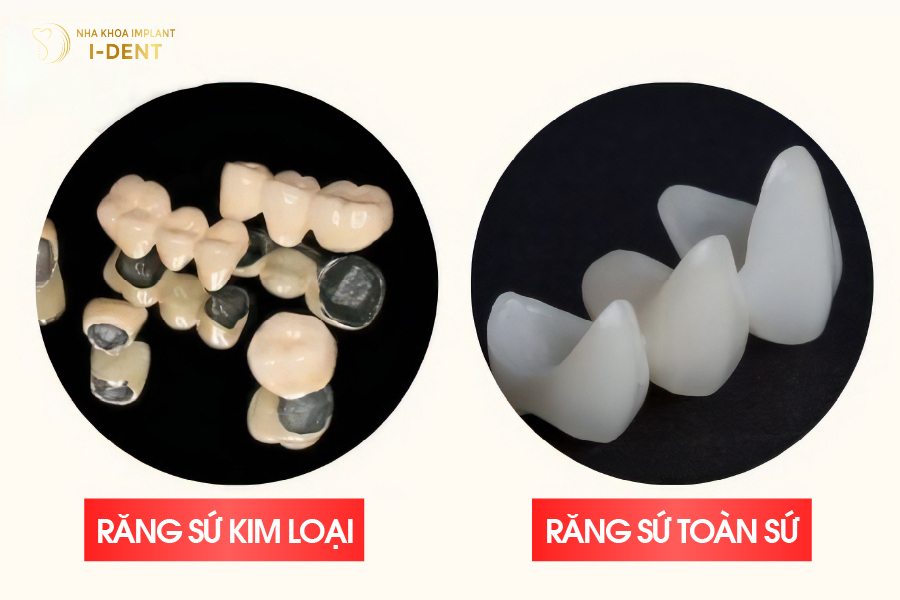 Trên thị trường phổ biến với 2 dòng sứ kim loại và toàn sứ Trên thị trường phổ biến với 2 dòng sứ kim loại và toàn sứ