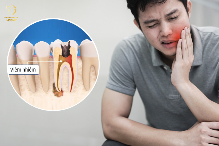 Răng bị viêm tủy gây đau nhức bọc răng sau khi lấy tủy