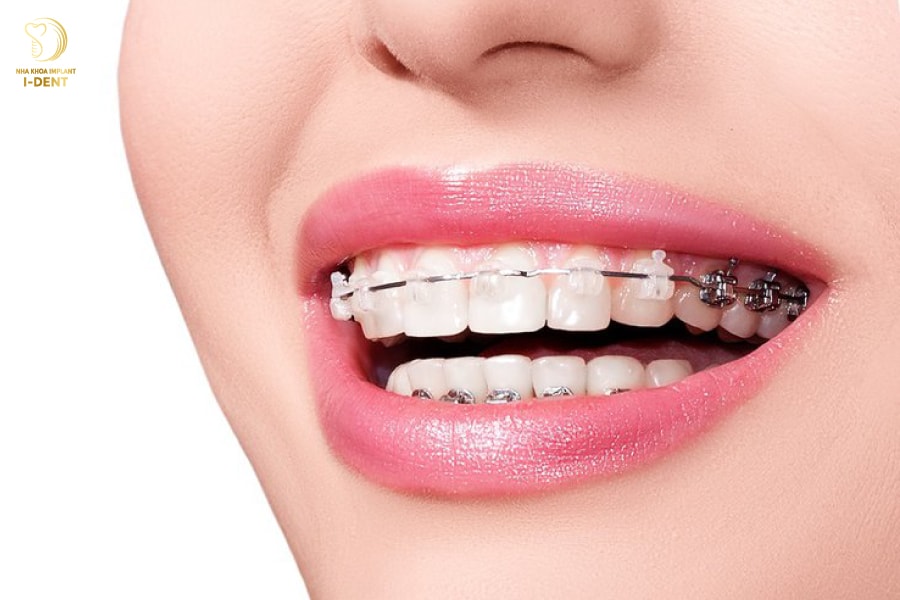 Răng chữa tủy có niềng được không? Răng chữa tủy có niềng được không?