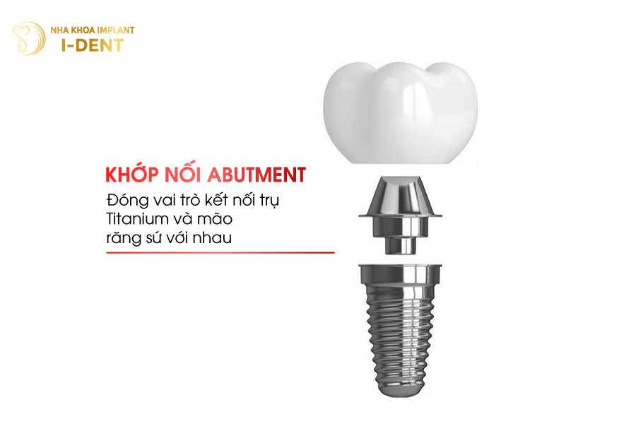 Cấu tạo răng Implant giống hệt như răng thật mất răng lâu năm có trồng được không