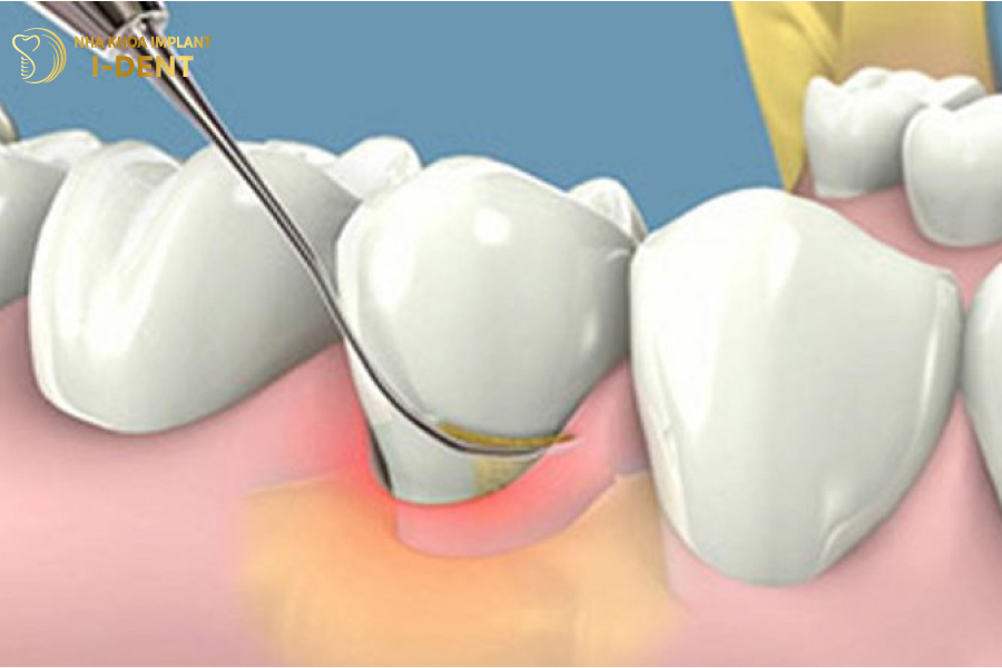 Cạo vôi răng giúp làm sạch răng miệng và kéo dài tuổi thọ trụ Implant Cạo vôi răng giúp làm sạch răng miệng và kéo dài tuổi thọ trụ Implant
