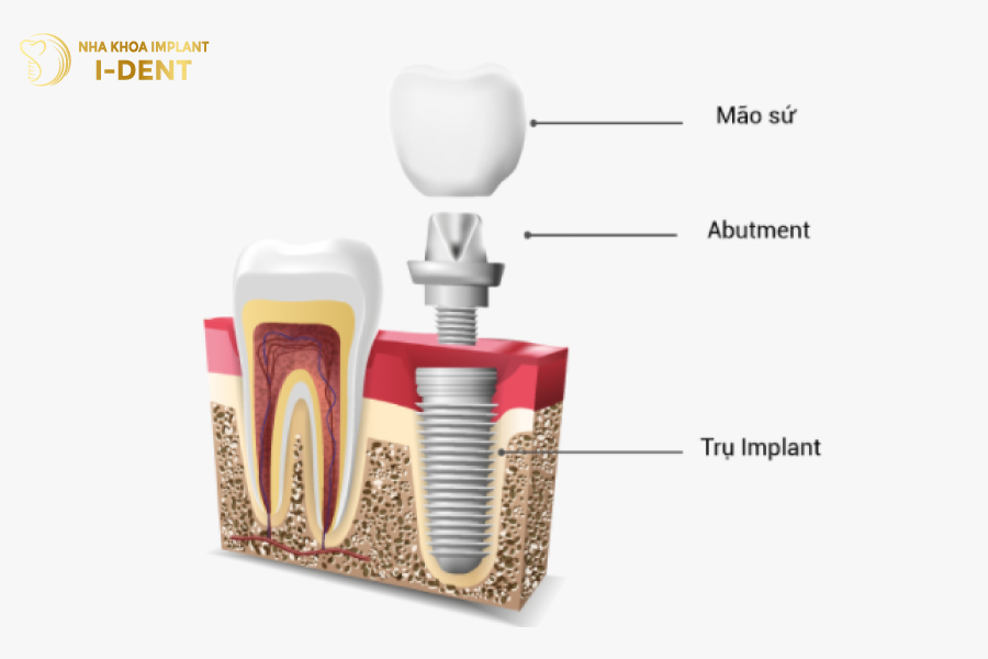 Cấu tạo trụ Implant Cấu tạo trụ Implant