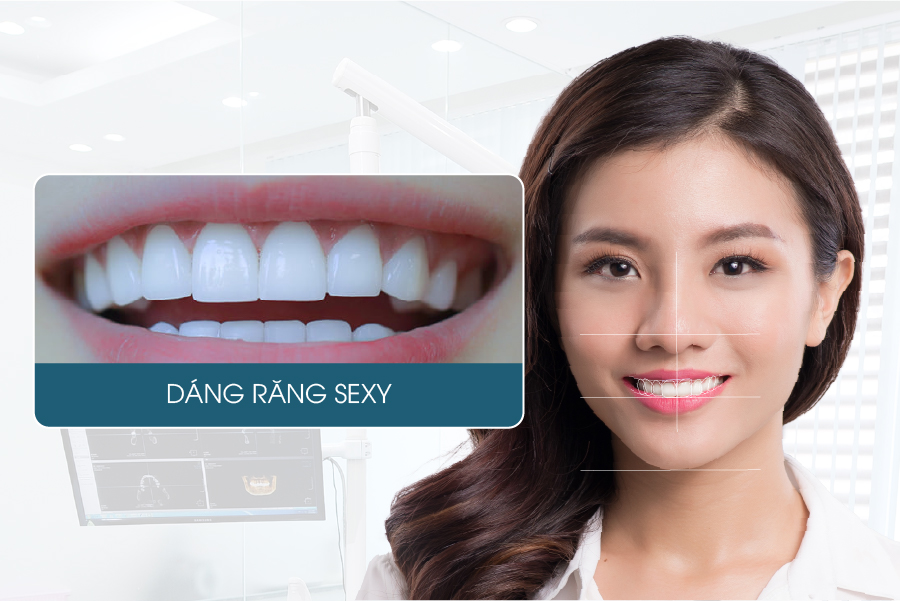 Dáng răng phong cách sexy form răng sứ đẹp