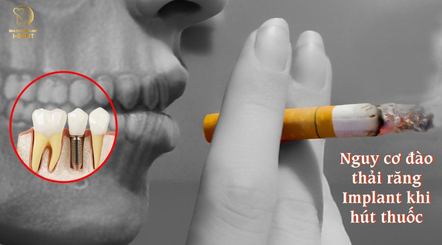 Người hút thuốc lá không thể cấy Implant Người hút thuốc lá không thể cấy Implant
