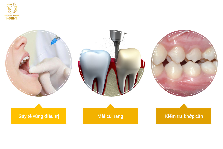 Tiến hành gây tê vùng điều trị và mài cùi răng Cách bọc răng sứ