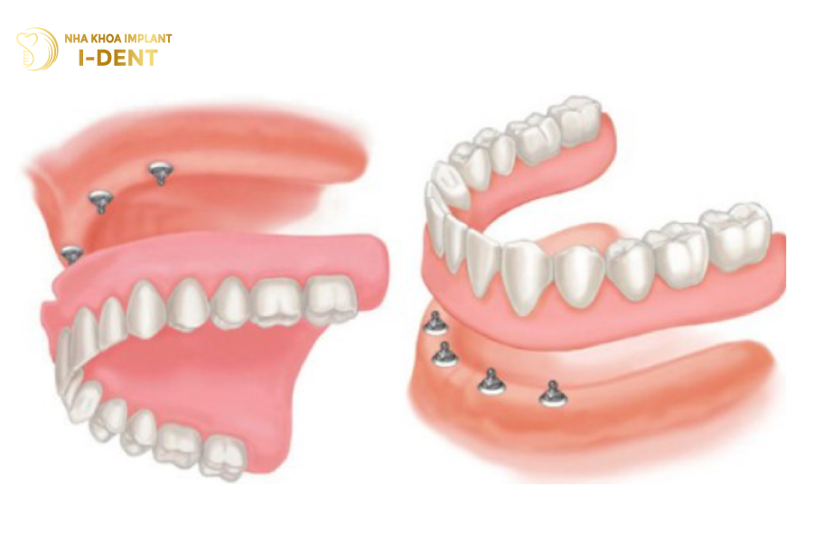 Hàm phủ trên Implant sau khi hoàn thiện Hàm phủ trên Implant sau khi hoàn thiện