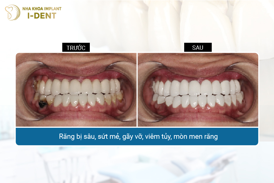 ốp răng sứ
