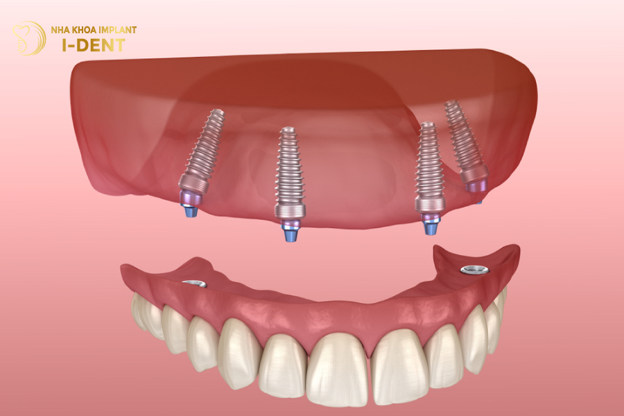 Hàm tháo lắp được lưu giữ bằng các khóa cài trực tiếp với Implant Hàm tháo lắp được lưu giữ bằng các khóa cài trực tiếp với Implant
