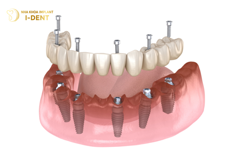 Implant Nobel phục hình cứng chắc khi cấy ghép toàn hàm All On Implant Nobel phục hình cứng chắc khi cấy ghép toàn hàm All On