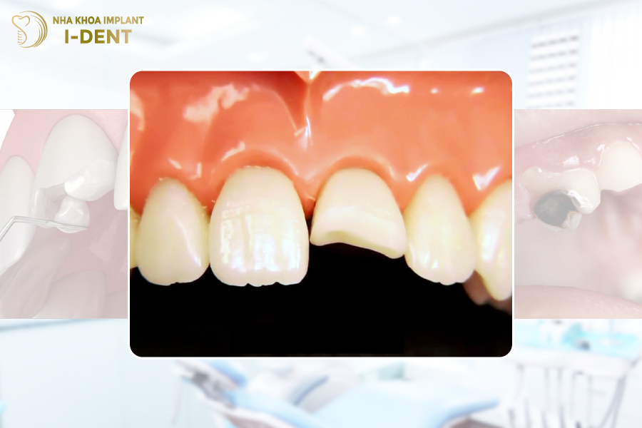 Không phải tình trạng răng nào cũng có thể dán sứ Veneer nhược điểm của dán răng sứ