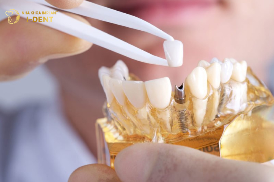 Sau khi trụ Implant tích hợp cứng chắc, bác sĩ sẽ lấy dấu làm răng sứ cấy ghép implant mất bao lâu