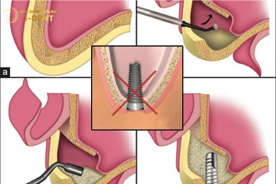 Nếu bệnh nhân ghép xương, nâng xoang sẽ kéo dài thời gian trồng răng cấy implant mất bao lâu
