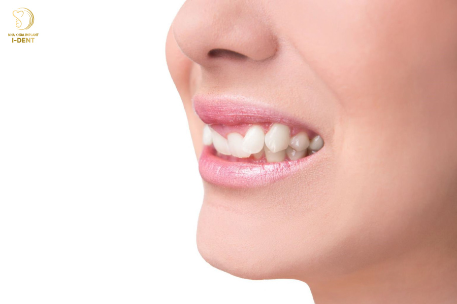 Răng bị khấp khểnh ảnh hưởng đến sức khỏe răng miệng Răng bị khấp khểnh ảnh hưởng đến sức khỏe răng miệng