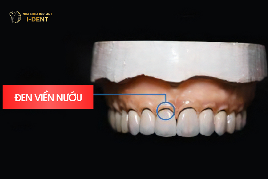 Viền nướu bị đen do sử dụng răng sứ Titan Viền nướu bị đen do sử dụng răng sứ Titan