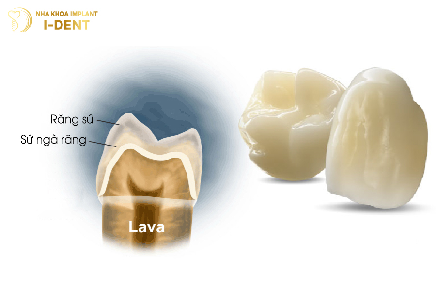 Răng sứ Lava Răng sứ Lava