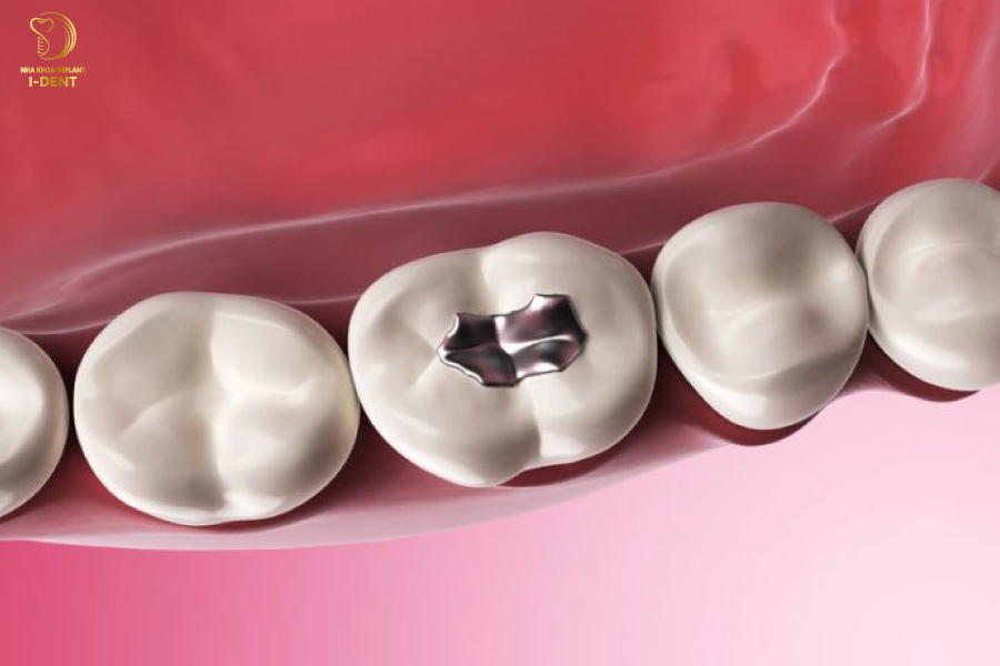 Trám răng bằng Amalgam Trám răng bằng Amalgam