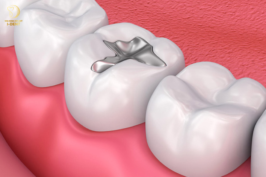Trám răng giá bao nhiêu?Trám răng bằng Amalgam Trám răng giá bao nhiêu?Trám răng bằng Amalgam