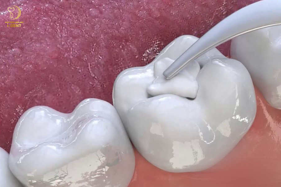 Chỉnh sửa lại chỗ trám Chỉnh sửa lại chỗ trám