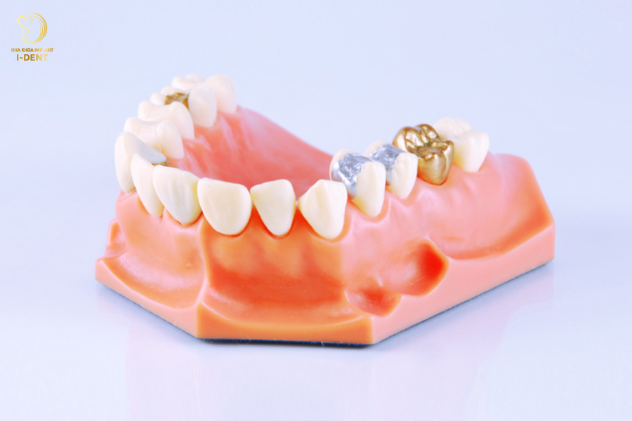 Trám răng bằng vàng và kim loại quý Trám răng bằng vàng và kim loại quý