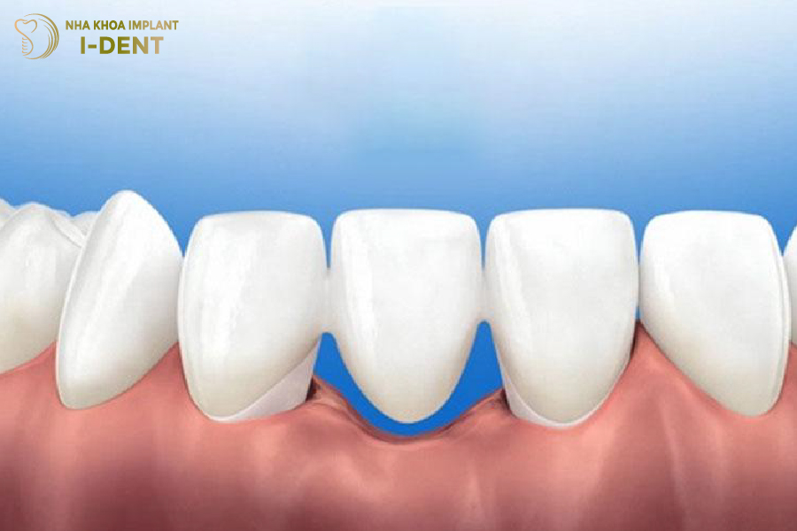 Ảnh hưởng các răng kề cận Ảnh hưởng các răng kề cận
