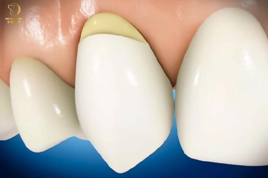 Cao răng là một trong những nguyên nhân gây nên mòn cổ chân răng Cao răng là một trong những nguyên nhân gây nên mòn cổ chân răng