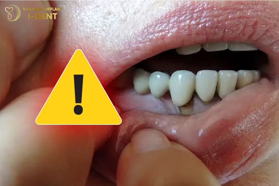 Bác sĩ tay nghề kém sẽ dễ mài răng sai tỷ lệ, khiến răng sứ lệch khỏi răng thật Bác sĩ tay nghề kém sẽ dễ mài răng sai tỷ lệ, khiến răng sứ lệch khỏi răng thật