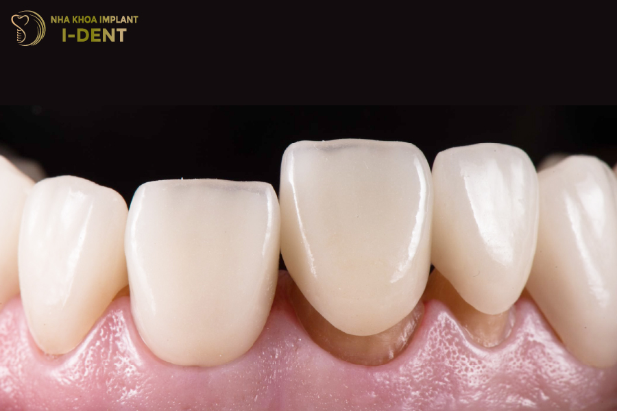Bác sĩ thực hiện sai kỹ thuật là nguyên nhân hàng đầu khiến lắp răng sứ bị kênh Bác sĩ thực hiện sai kỹ thuật là nguyên nhân hàng đầu khiến lắp răng sứ bị kênh
