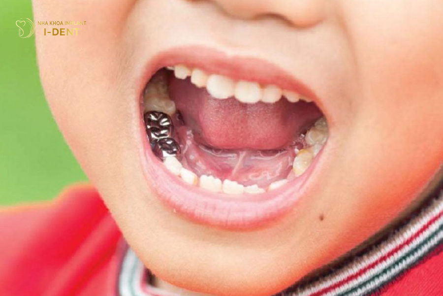 Bé hoàn tất quá trình bọc răng sứ Bé hoàn tất quá trình bọc răng sứ