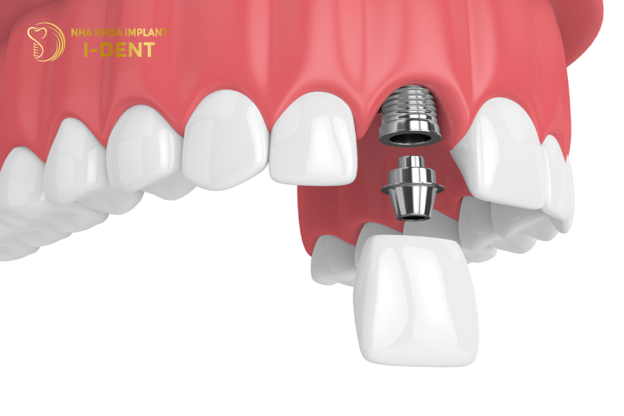 Biện pháp phục hình răng cửa đã mất Biện pháp phục hình răng cửa đã mất