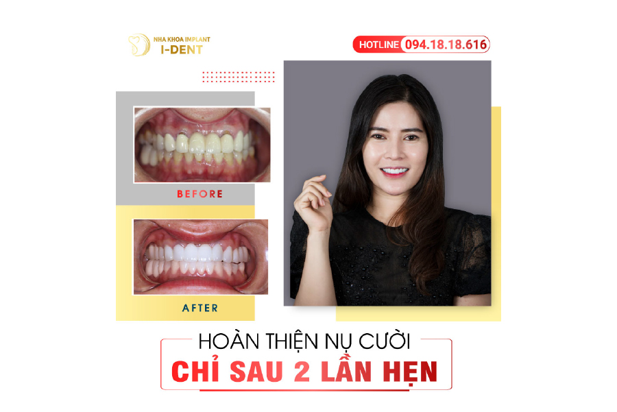 Bọc răng sứ giúp cải thiện thẩm mỹ cho răng một cách tự nhiên nhất Bọc răng sứ giúp cải thiện thẩm mỹ cho răng một cách tự nhiên nhất