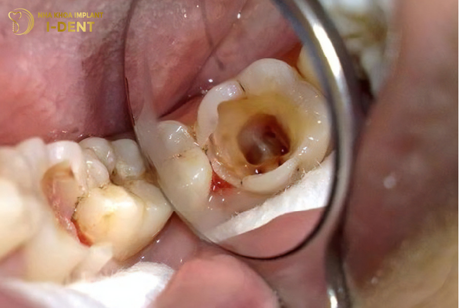 Mất răng do bị viêm tủy răng Mất răng do bị viêm tủy răng