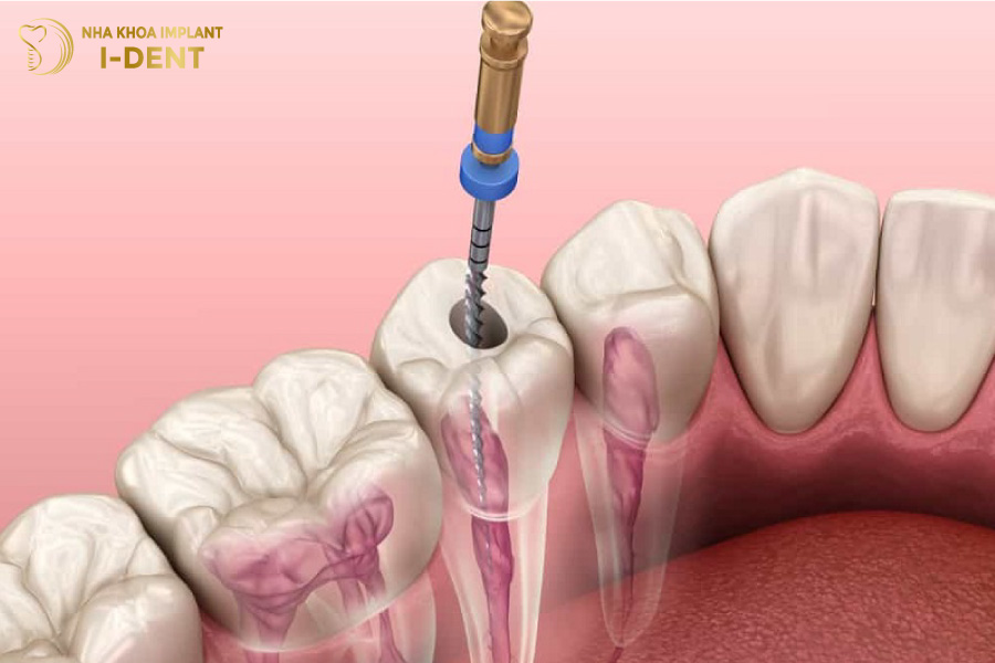 Thực hiện lấy tủy răng lấy tủy bọc răng sứ giá bao nhiêu