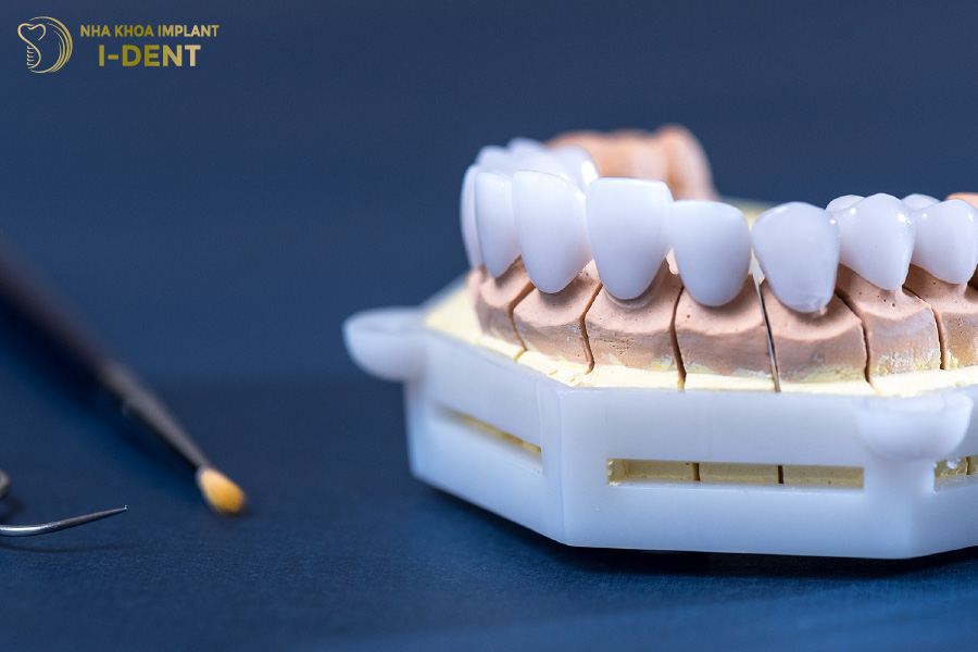 Bọc răng sứ Vita Đức được đánh giá cao về tính thẩm mỹ Bọc răng sứ Vita Đức được đánh giá cao về tính thẩm mỹ