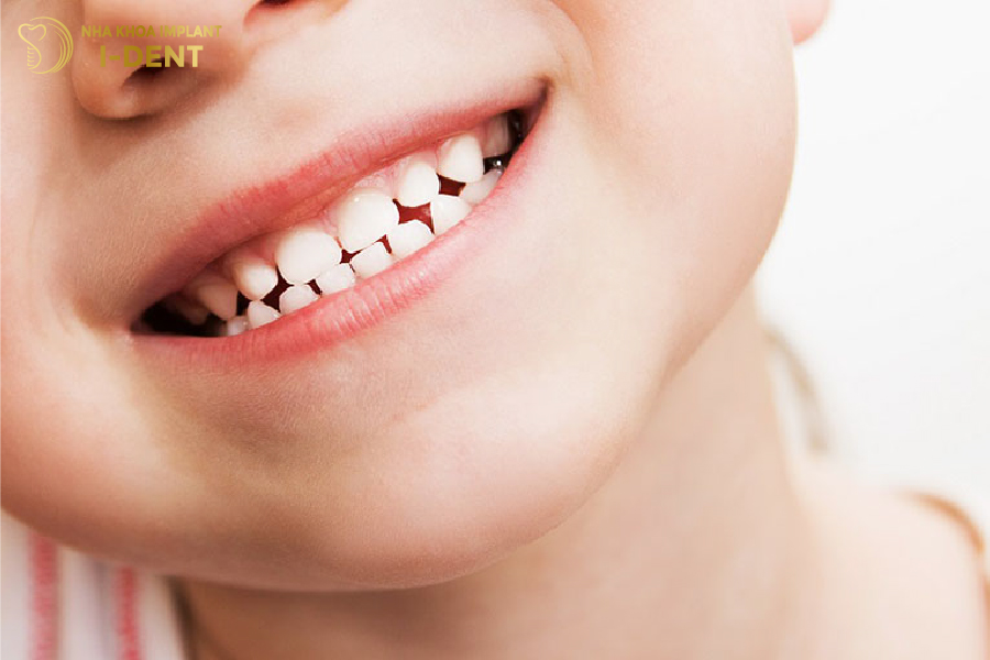 Bọc sứ cho trẻ có thể gây cản trở việc mọc răng Bọc sứ cho trẻ có thể gây cản trở việc mọc răng