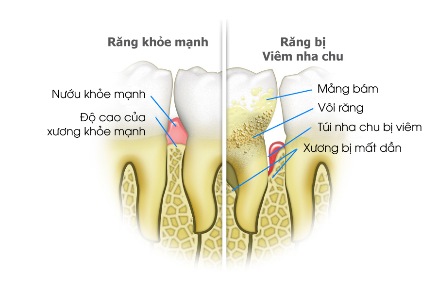 Dễ mắc các bệnh răng miệng khác nhổ răng cấm không trồng lại có sao không