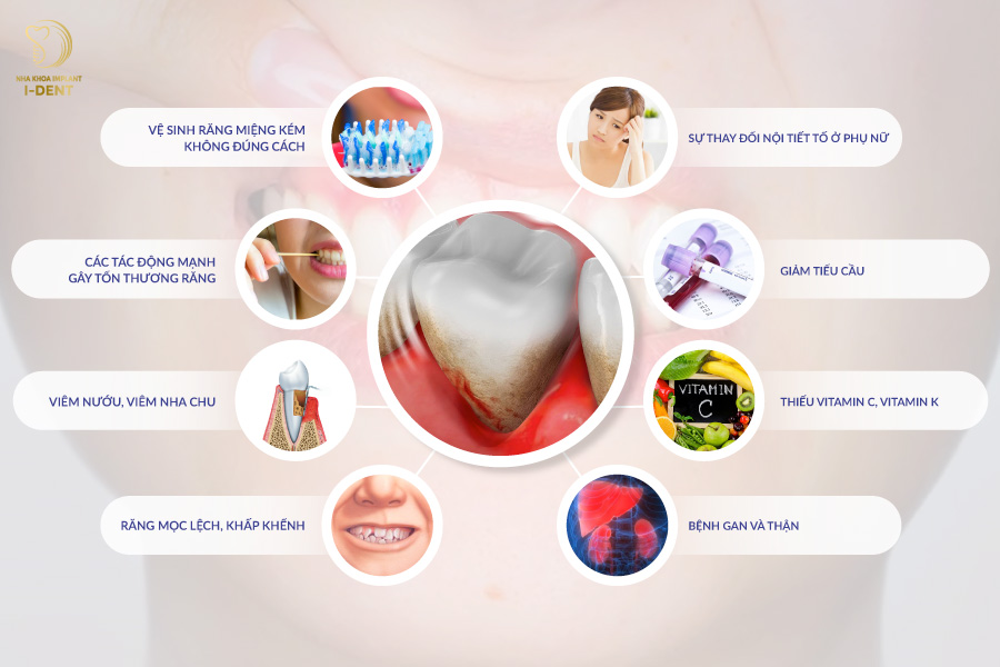 Các nguyên nhân gây chảy máu chân răng Các nguyên nhân gây chảy máu chân răng