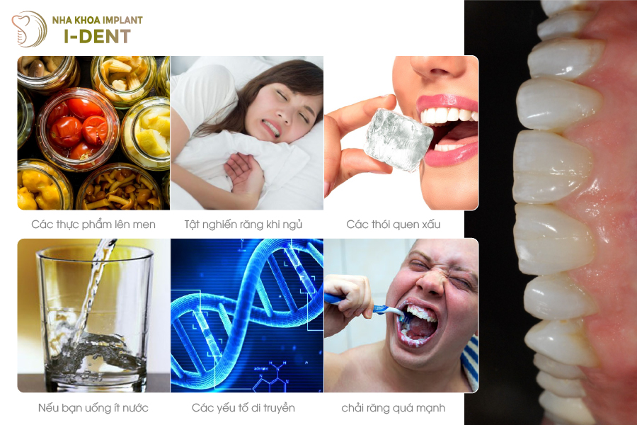 Các nguyên nhân khiến răng sứ bị mòn Các nguyên nhân khiến răng sứ bị mòn