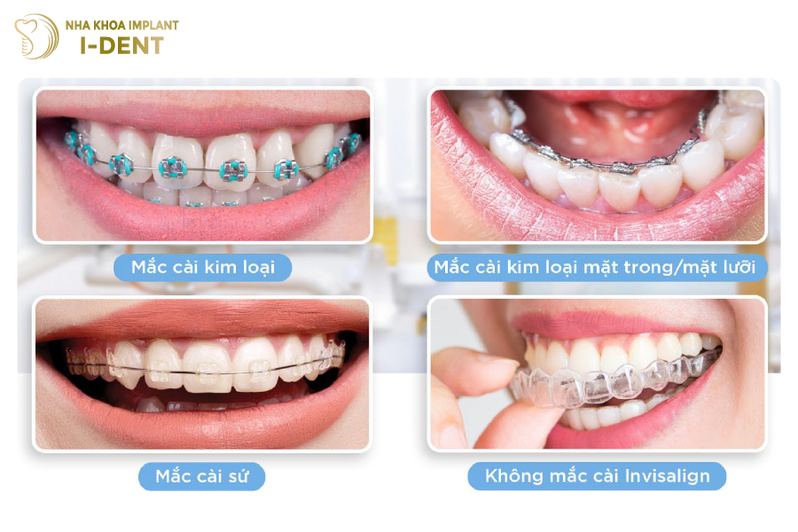 Các phương pháp niềng răng phổ biến hiện nay Các phương pháp niềng răng phổ biến hiện nay
