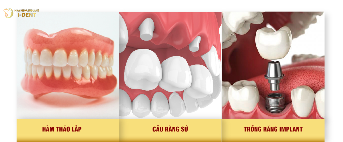 Trồng răng giả mất bao lâu? - Các phương pháp trồng răng giả hiện nay phương pháp trồng răng