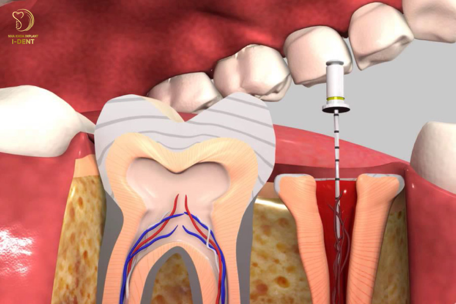 Viêm tủy sau bọc sứ khiến bạn tốn kém thời gian và tiền bạc để điều trị lại từ đầu Viêm tủy sau bọc sứ khiến bạn tốn kém thời gian và tiền bạc để điều trị lại từ đầu
