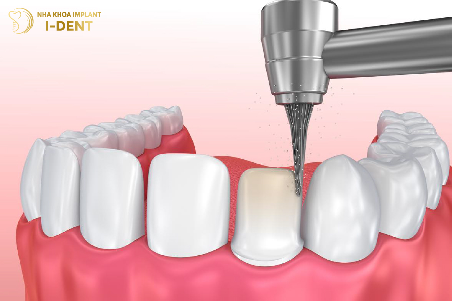 Bác sĩ mài răng quá nhiều sẽ khiến răng bị tổn thương và đau nhức Bác sĩ mài răng quá nhiều sẽ khiến răng bị tổn thương và đau nhức