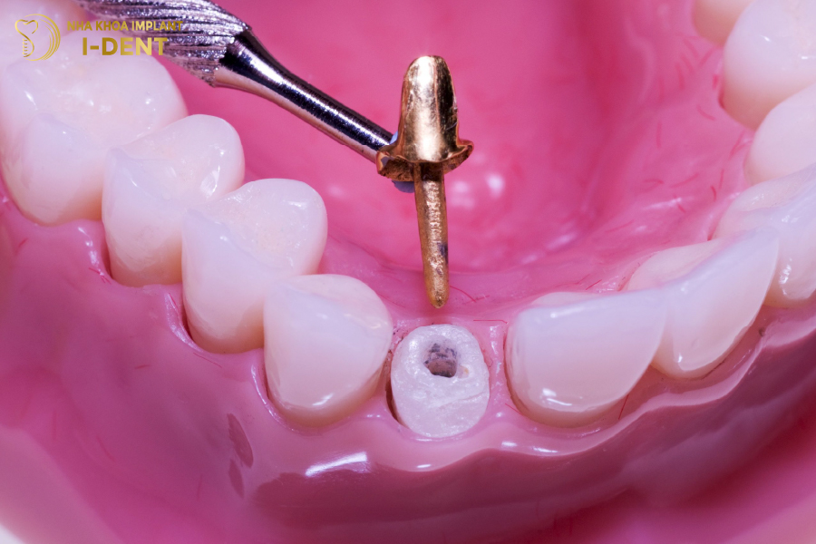 gãy răng cấm có ảnh hưởng gì không