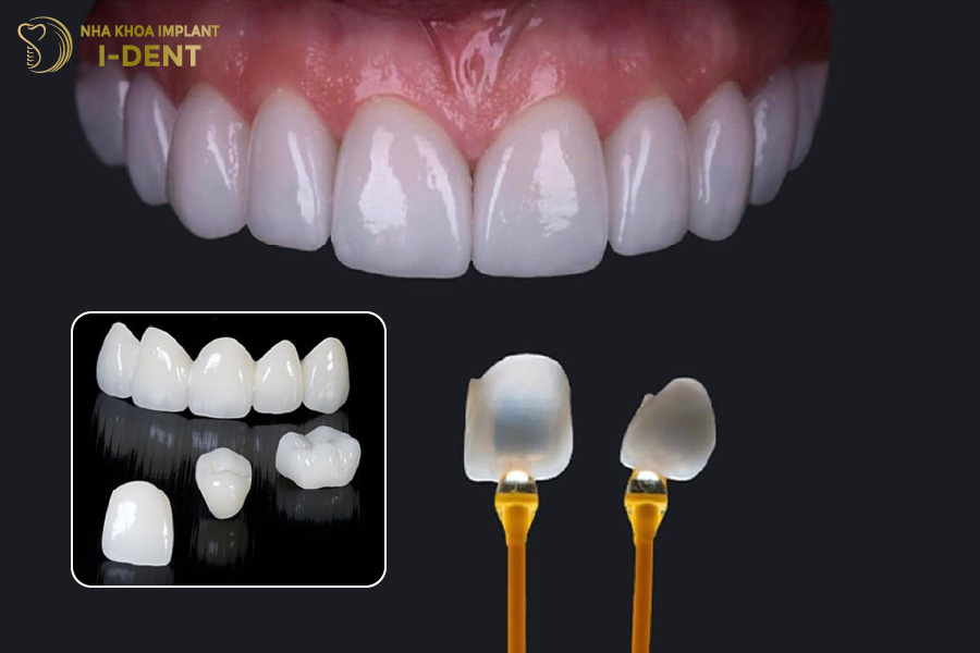 Cận cảnh răng sứ Nacera 9Max và mặt dán sứ Veneer Lisi Press Ultra Thin Cận cảnh răng sứ Nacera 9Max và mặt dán sứ Veneer Lisi Press Ultra Thin