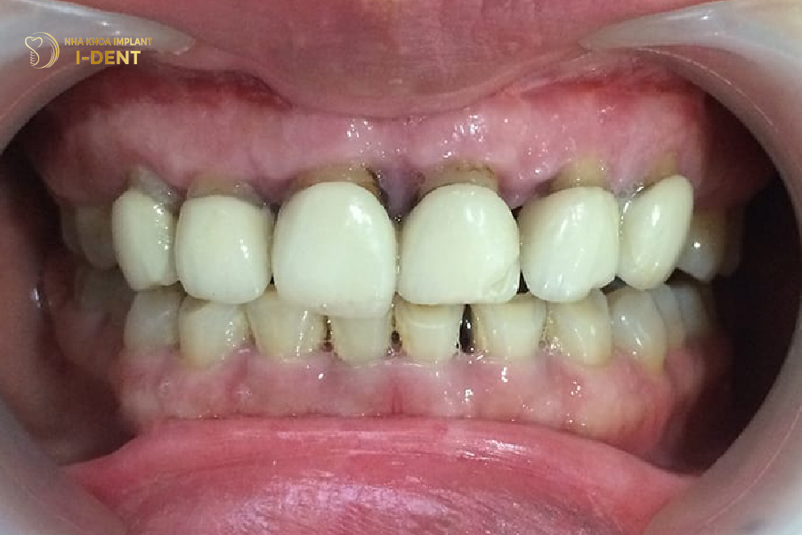 Cẩn thận với những quảng cáo bọc sứ giá rẻ Cẩn thận với những quảng cáo bọc sứ giá rẻ