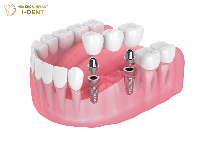 Cầu răng có Implant hỗ trợ Cầu răng có Implant hỗ trợ