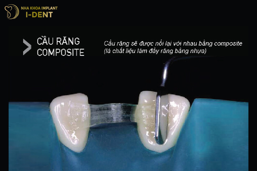 Cầu răng Composite Cầu răng Composite